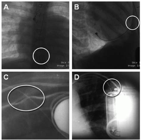 Introduction and Overview of Pacemaker/ICD Therapy in ...