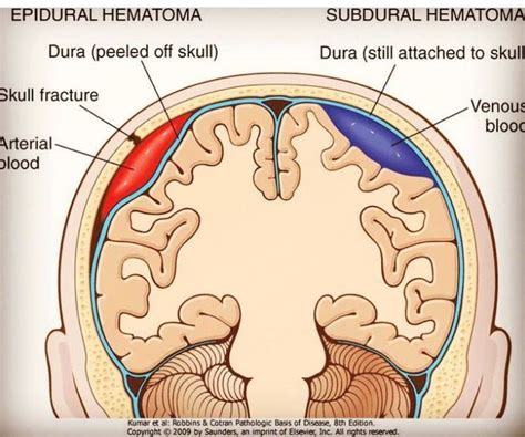 Epidural Hematoma Vs Subdural Hematoma MEDizzy