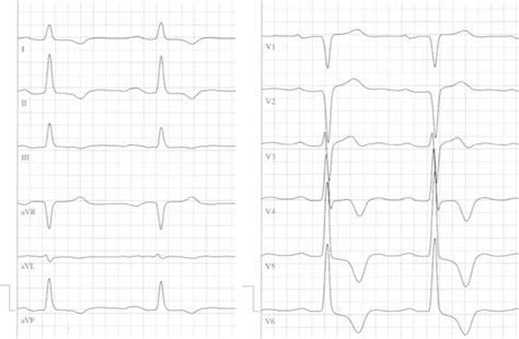 Electrocardiography Negative T‐waves And A Positive Sokolovlyon Score