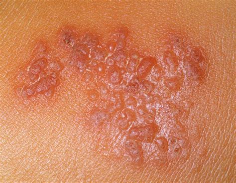 9 Häufige Hautausschläge Mit Blasen