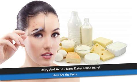Dairy And Acne Does Dairy Cause Acne Here Are The Facts