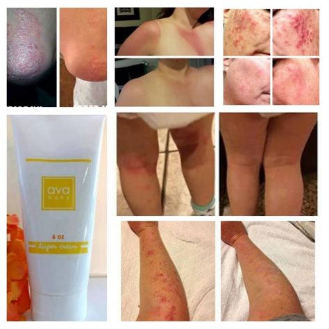 Do You Have Eczema Psoriasis Dry Itchy Skin Do You Have Unexplained