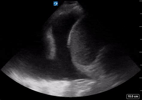Ultrasound Pleural Effusion And Spine Sign Rkmd