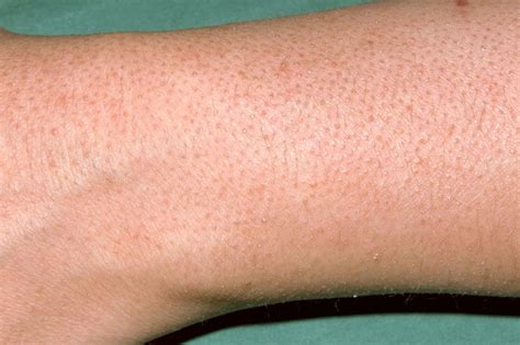 Keratosis Pilaris Chicken Skin Nhsuk