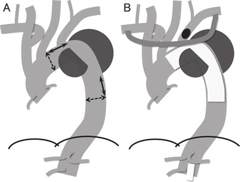 Schema Of Thoracic Endovascular Aortic Repair A Use Of The GORE CTAG