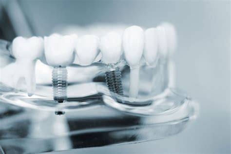 Implantes dentales de titanio qué debes saber Nart Clínica Dental