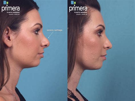 Revision Rhinoplasty Before And After Pictures Case 243 Orlando