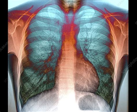 Healthy Lungs X Ray Stock Image C0488764 Science Photo Library