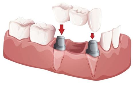 They are made of crowns that are fixed on. Dental Bridges Jackson MS | General Dentistry | Mosal Dental Care