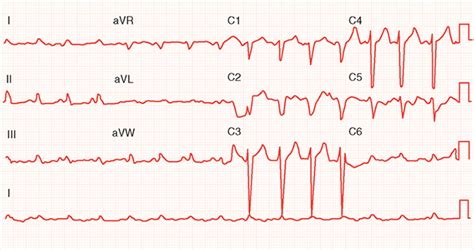 Dilated And Restrictive Cardiomyopathies