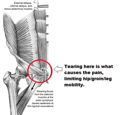 Surgery, for example tenotomy of the adductor. Under Pressure: Will Bobby Ryan score 30 or more in 2014 ...