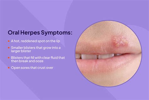 Herpes Vesicles Early Stage