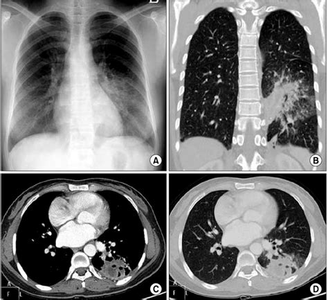 A Chest Radiograph On Admission Showed A Patchy Consolidation In The