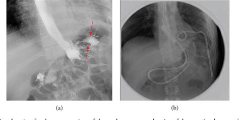 Figure 1 From Gastropleural Fistula As A Rare Complication Of Gastric