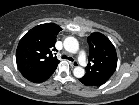 Lymphoma With Supraclavicular Nodes And Sternal Tumor Chest Case