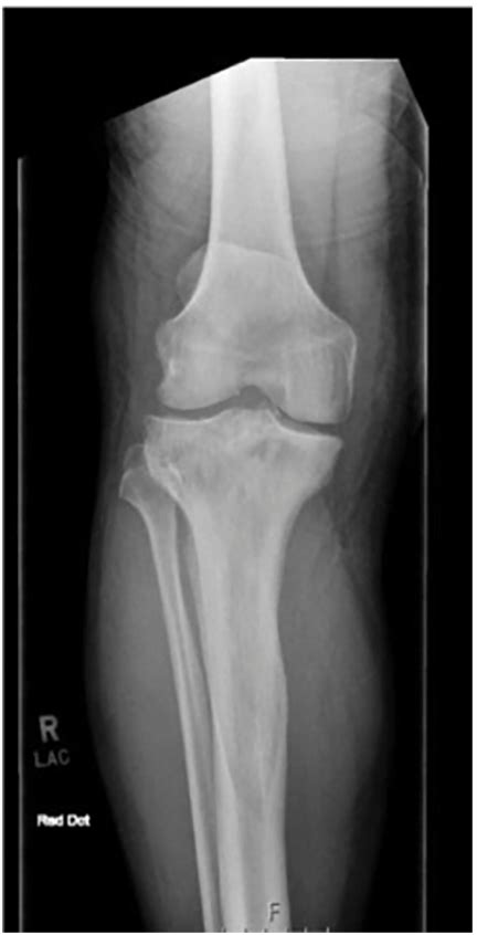 Right Knee Ap Radiograph Showing Avulsion Fracture Of The Tibial