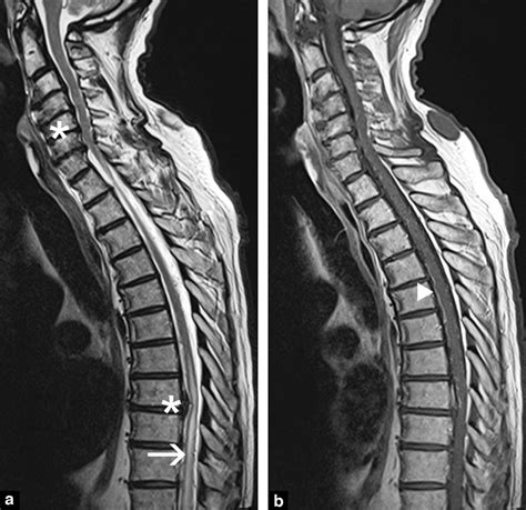 Abnormal Thoracic Spine Mri