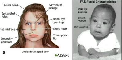 My 19 m.o has epicanthal folds and flat nasal bridge but no other. Flat Nasal Bridge And Epicanthal Folds - Facial Features Of Proband Newborn Note Broad Forehead ...