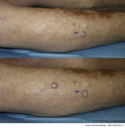 Mobile Nodules On The Legs Actas Dermo Sifiliográficas