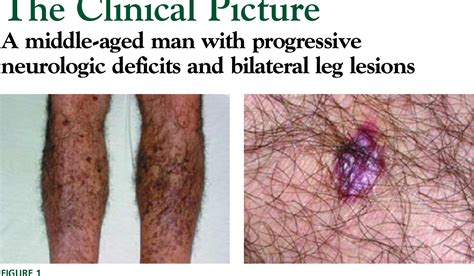 Figure 1 From A Middle Aged Man With Progressive Neurologic Deficits