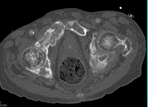 Widespread Blastic Bone Metastases From Prostate Cancer