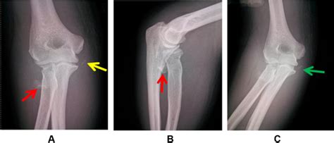Severe Traumatic Valgus Instability Of The Elbow Pathoanatomy And