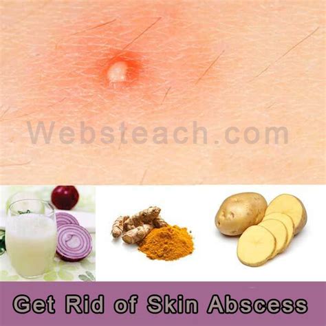 Learn All About How To Get Rid Of Abscess We Will Cover About Skin