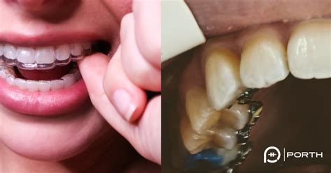 How Long Does It Take For Lingual Braces To Work Dr Wang S Experience