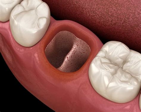 CirugÍa Bucal Alveolitis Dental Sepa Cómo Prevenirla Directorio