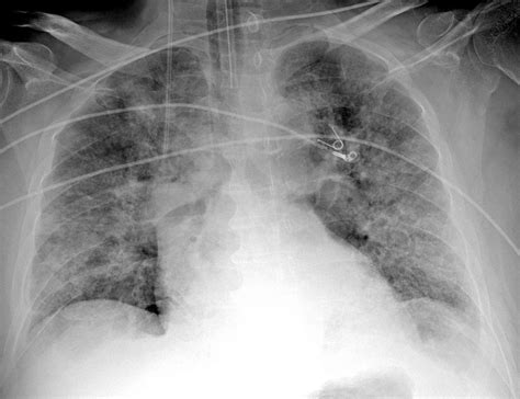 Pneumonia Chest X Ray Aspiration Pneumonia Radiology At St Vincent S A Basic