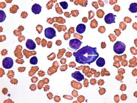 An Unusual Case Of Severe Anaemia And Lymphocytosis The Bmj
