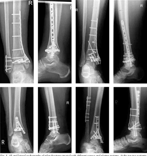 Figure 1 From Distal Tibial Fractures And Pilon Fractures Semantic