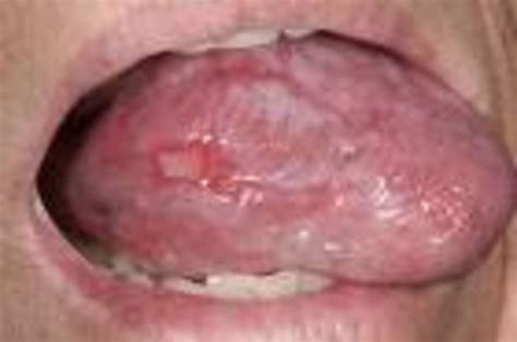 Natural Treatment And Cure For Oral Lichen Planus Hubpages