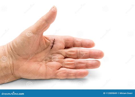 Hand Surgery Of A Dupuytren`s Disease Contracture Or A Trigger Stock