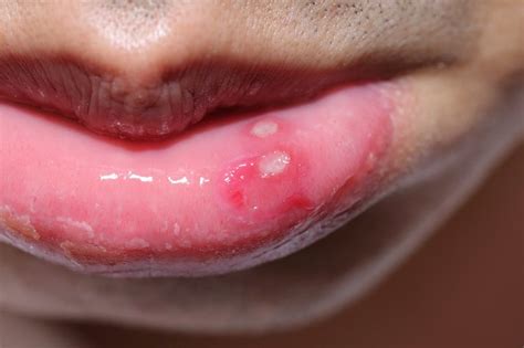 What Causes Canker Sores And Fever Blisters American Dental Care