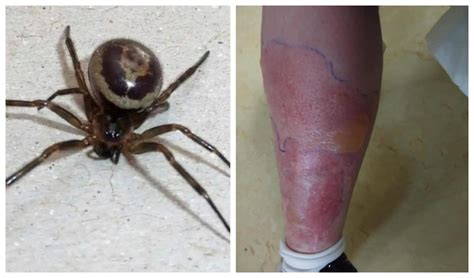 The Worst Spider Bite Pictures Including The Brown Re