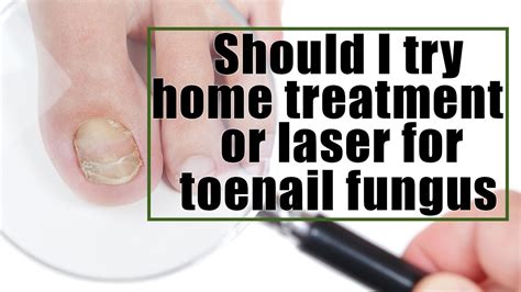 Should I Try Home Treatment Or Laser For Toenail Fungus YouTube