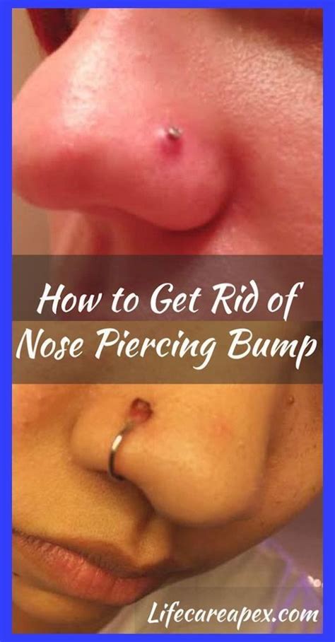 I take it daily till the lump goes away. How to Get Rid of Nose Piercing Bump | How To Get Rid Of A ...