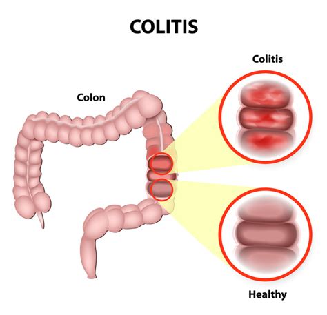 Manage Your Ulcerative Colitis Naturally Night Helper