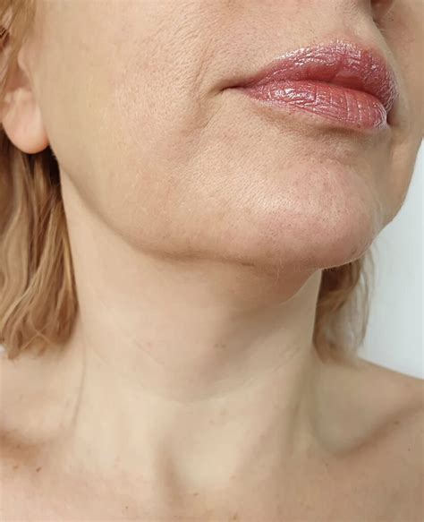 Face Drop And Facial Palsy Face Restoration Facial Aesthetics