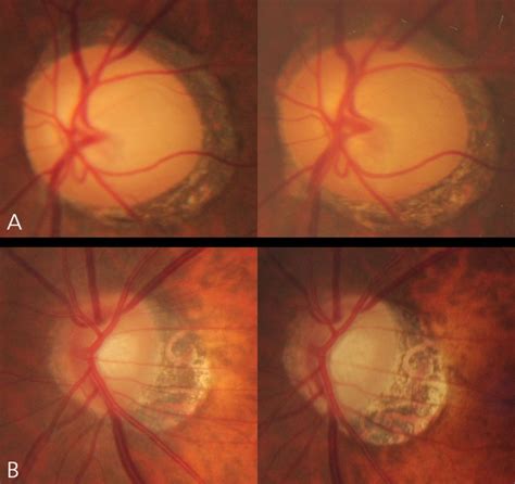 Progressive Change In Peripapillary Atrophy In Myopic Glaucomatous Eyes