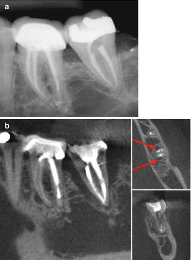Diagnosis Of Vertical Root Fractures Pocket Dentistry