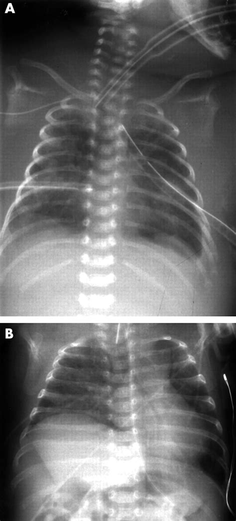 Extubation Failure Due To Phrenic Nerve Injury Adc Fetal And Neonatal