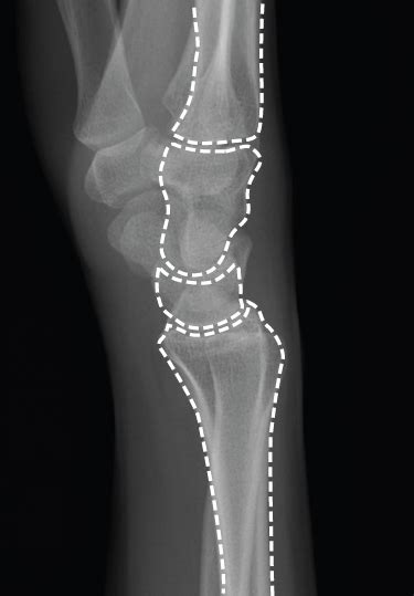 Lateral Wrist Radiograph Anatomy