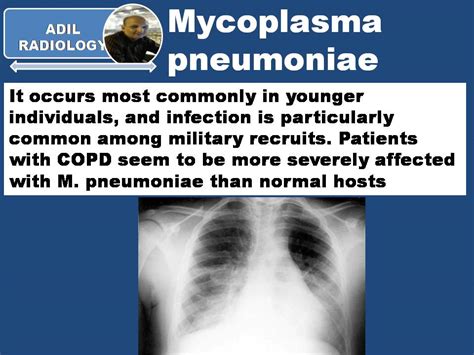 Mycoplasma Pneumoniae Radiology Classroom