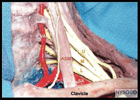 Supraclavicular Brachial Plexus Block Nysora The New York School Of