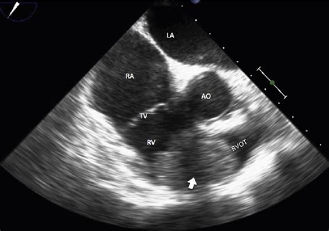 Transesophageal Echocardiogram Right Ventricular Inflow And Outflow