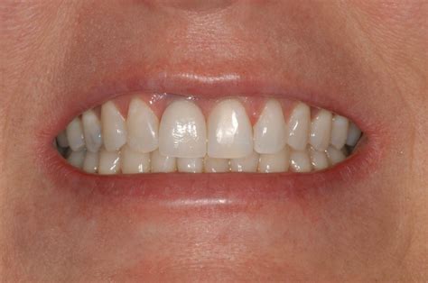 Single Front Implant Tooth Dallas Dental Implant Center