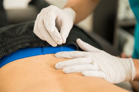 3 benefits of dry needling physical therapy specialists