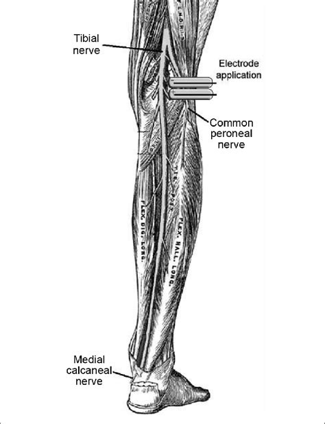 Electrode Application On The Common Peroneal Nerve Illustration Of The